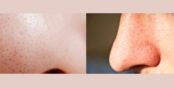 Whiteheads vs Blackheads: know the difference between Blackheads and Whiteheads 