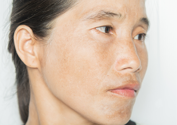 Why Does Skin Get Dark in Winter and How to Get Rid of It?