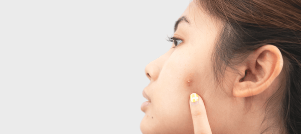 Why we get pimples on face