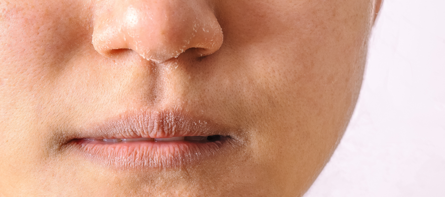 Winter Skin Issues 