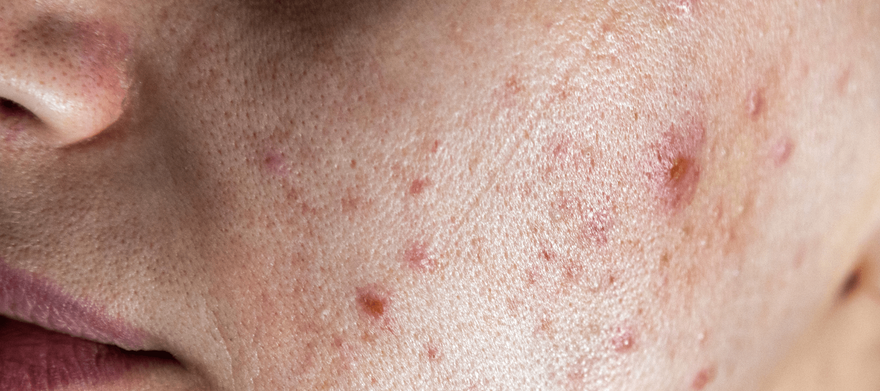 Zinc PCA Benefits for Acne Skin, Illustrating the product that can help acne-prone skin