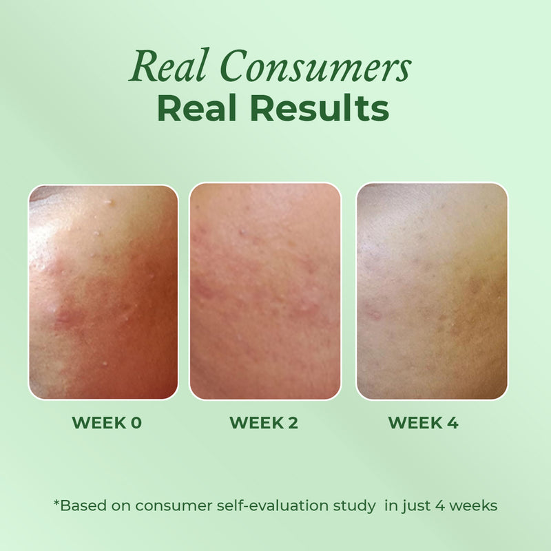Consumer results after using the acne moisturiser by The Pink Foundry