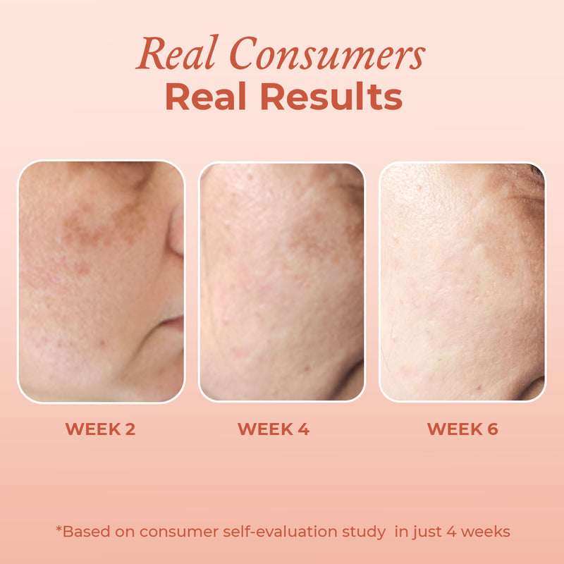 Consumer results after using the hyperpigmentation serum by The Pink Foundry