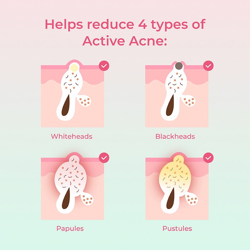 Overnight Acne Spot Corrector Type of Acnes