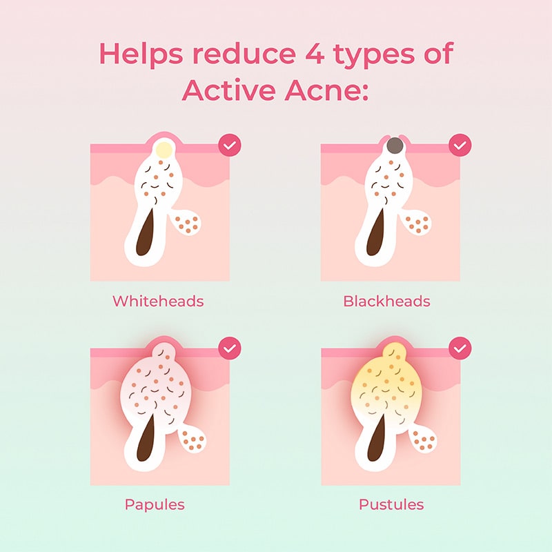 Types of acne treated by the acne spot corrector from The Pink Foundry