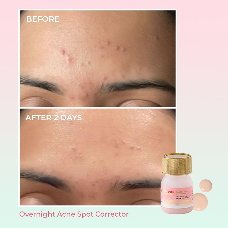 Before and after using Overnight Acne Spot Corrector from The Pink Foundry