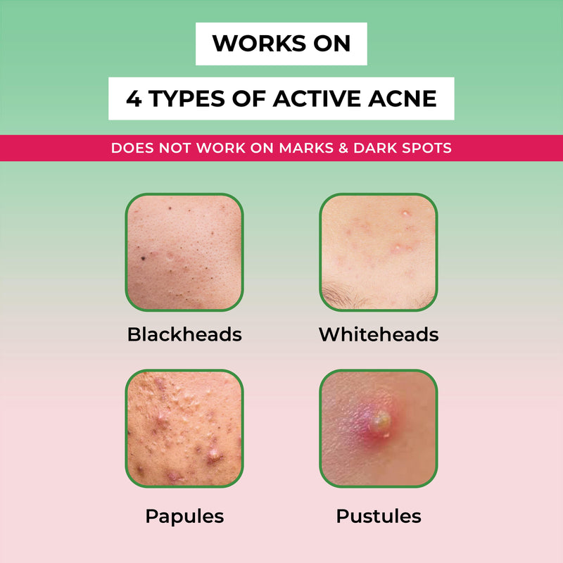 Types of acne treated by the acne spot corrector from The Pink Foundry