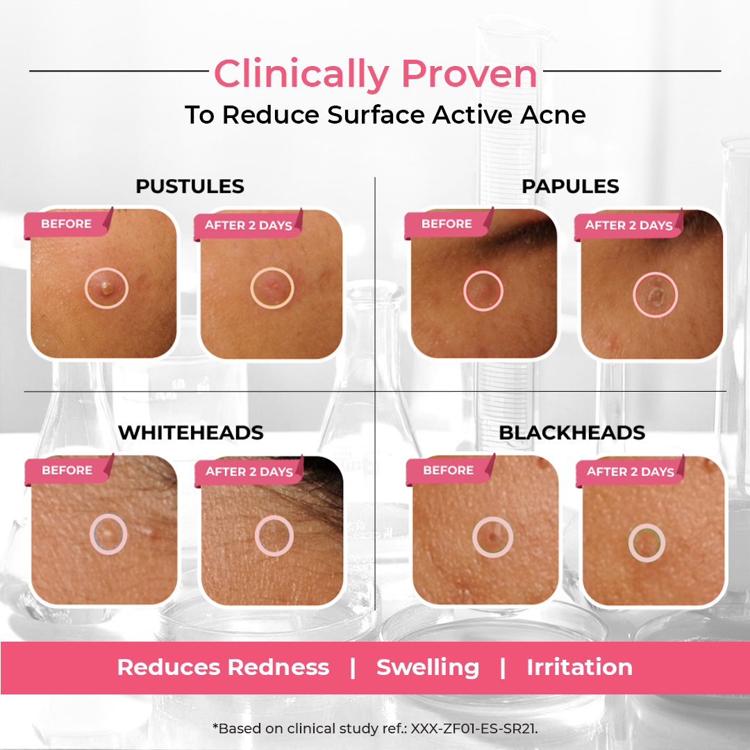 Overnight Acne Spot Corrector 30 ml