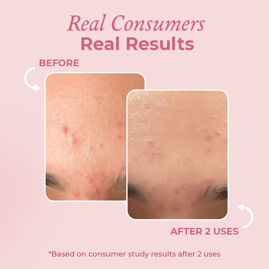 Acne + Pigmentation Relief Duo