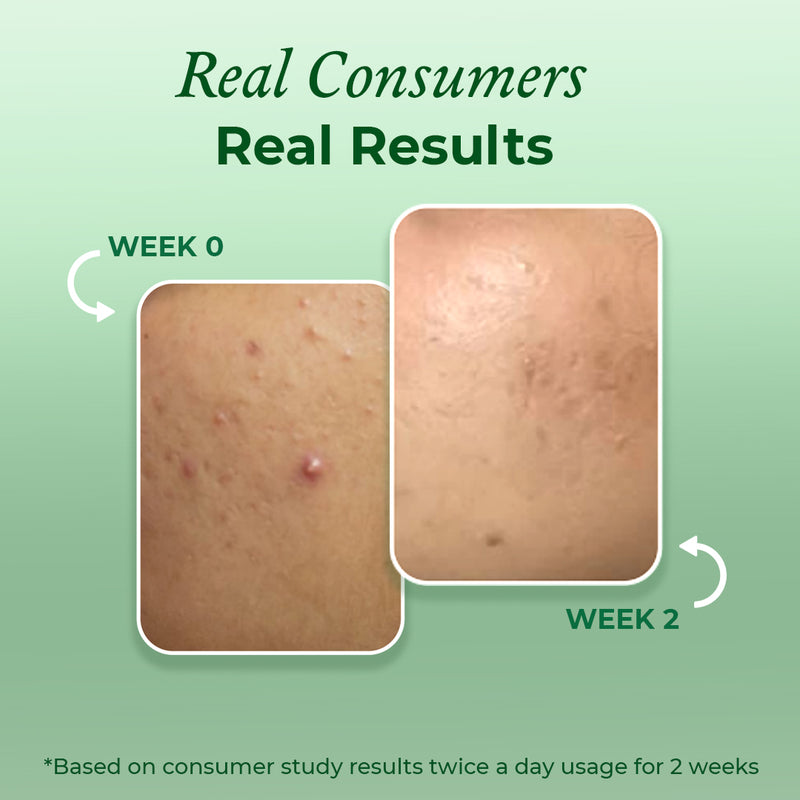 Consumer results after using the acne face wash by The Pink Foundry