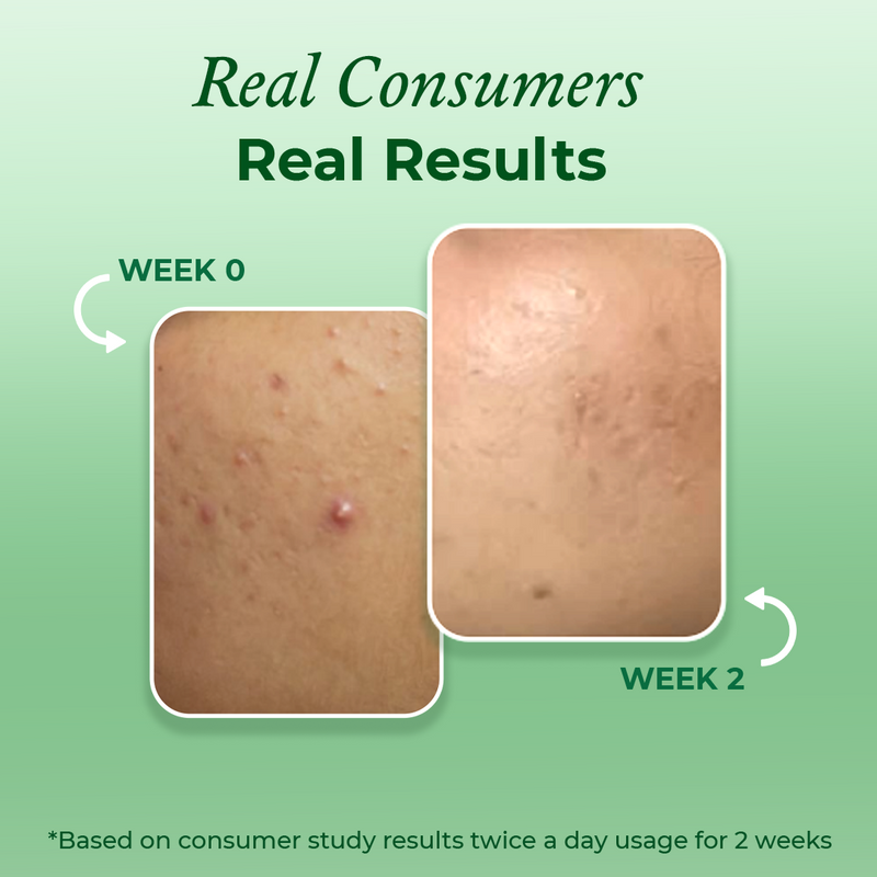 Consumer results after using the mini acne face wash from The Pink Foundry